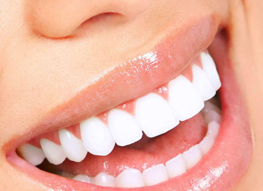 Aclaramiento Dental
